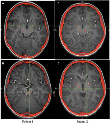 Application of deep brain stimulation for the treatment of childhood-onset dystonia in patients with MEPAN syndrome
